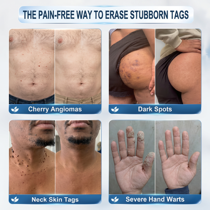 𝐎𝐟𝐟𝐢𝐜𝐢𝐚𝐥 𝐔𝐊 𝐒𝐭𝐨𝐫𝐞 👩‍⚕️|💕 𝐕𝐢𝐭𝐚𝐥𝐢𝐬𝐲𝐬® 7-Day Tag & Spot Eraser (Zero Pain, Zero Scars Rollerball)